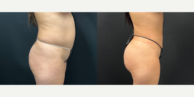 Lipo 360 BBL before and after photo