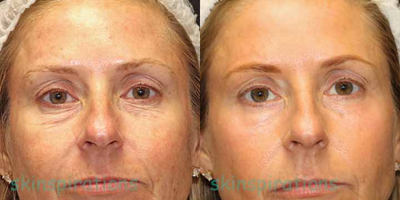 ProFractional Laser before and after photo