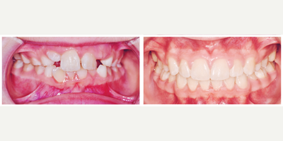 Braces before and after photo