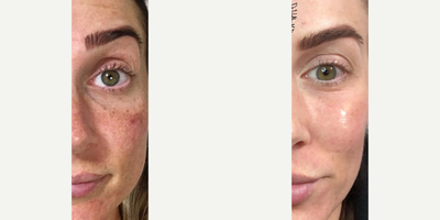 Aquagold before and after photo