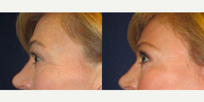 Brow Lift before and after photo