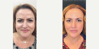 Dermal Fillers before and after photo