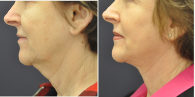 Facelift before and after photo