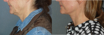 Lower Facelift before and after photo