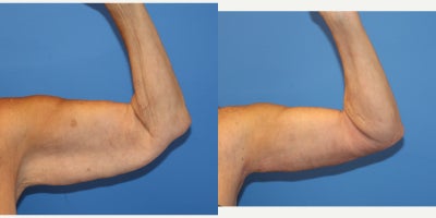 Arm Lift before and after photo