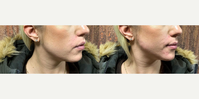 Dermal Fillers before and after photo