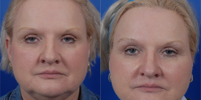 Facelift before and after photo