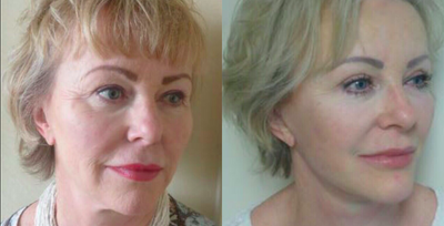 Facelift before and after photo