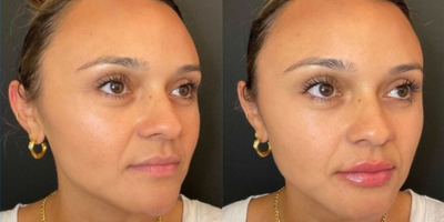 Lip Fillers before and after photo