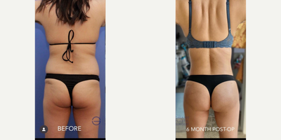 Abdominal Etching before and after photo