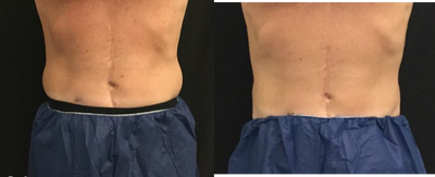 CoolSculpting before and after photo