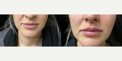 Dermal Fillers before and after photo