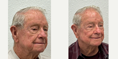 Facial Reconstructive Surgery before and after photo