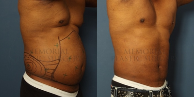 Liposuction before and after photo