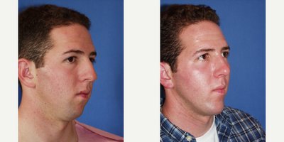 Rhinoplasty before and after photo