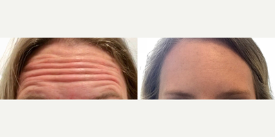 Botox before and after photo