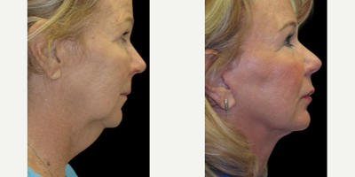 Lip Fillers before and after photo