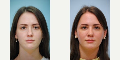 Rhinoplasty before and after photo