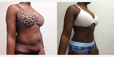 Tummy Tuck before and after photo
