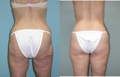 Body Lift before and after photo