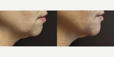 Chin Filler before and after photo