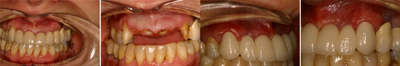 Dental Implants before and after photo
