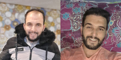 FUE Hair Transplant before and after photo