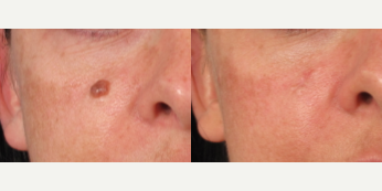 Mole Removal before and after photo