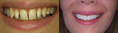 Porcelain Veneers before and after photo