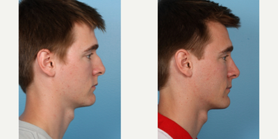 Rhinoplasty before and after photo