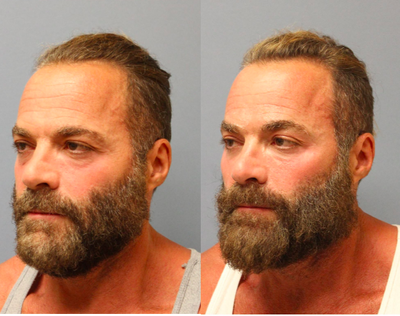 Cheek Fillers before and after photo