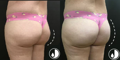 Emsculpt before and after photo
