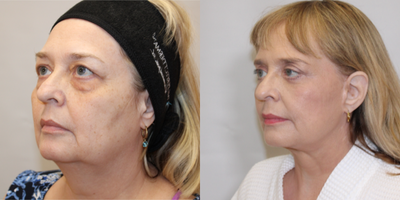 Facelift before and after photo