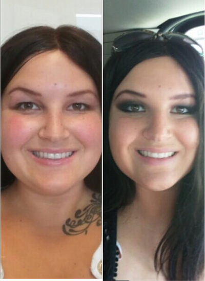 Kybella before and after photo