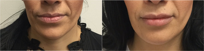Lip Fillers before and after photo