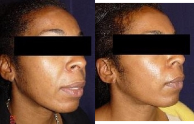 Radiesse before and after photo