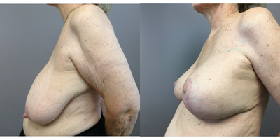 Breast Lift with Implants before and after photo