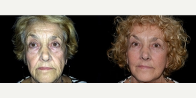 Facelift before and after photo