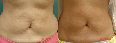 Thermage before and after photo