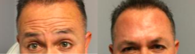 Botox before and after photo