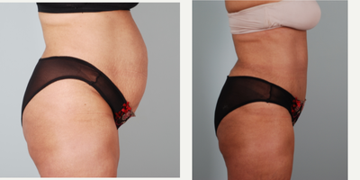 Drainless Tummy Tuck before and after photo