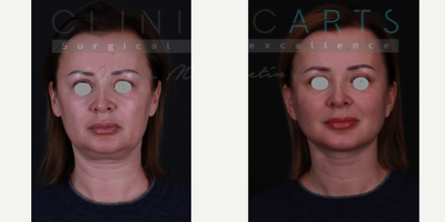 Facelift before and after photo