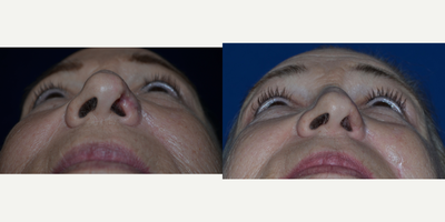 Facial Reconstructive Surgery before and after photo