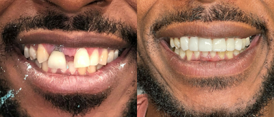 Lumineers before and after photo