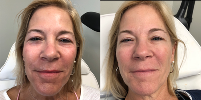 Microneedling before and after photo