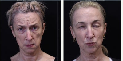 Botox before and after photo