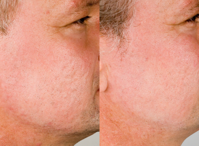 CO2 Laser before and after photo