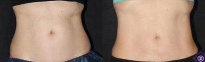 CoolSculpting before and after photo