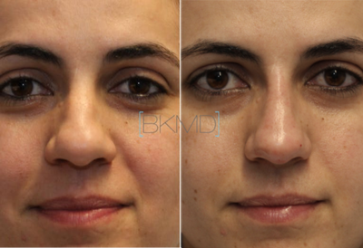 Nonsurgical Nose Job before and after photo