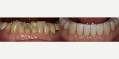 Porcelain Veneers before and after photo